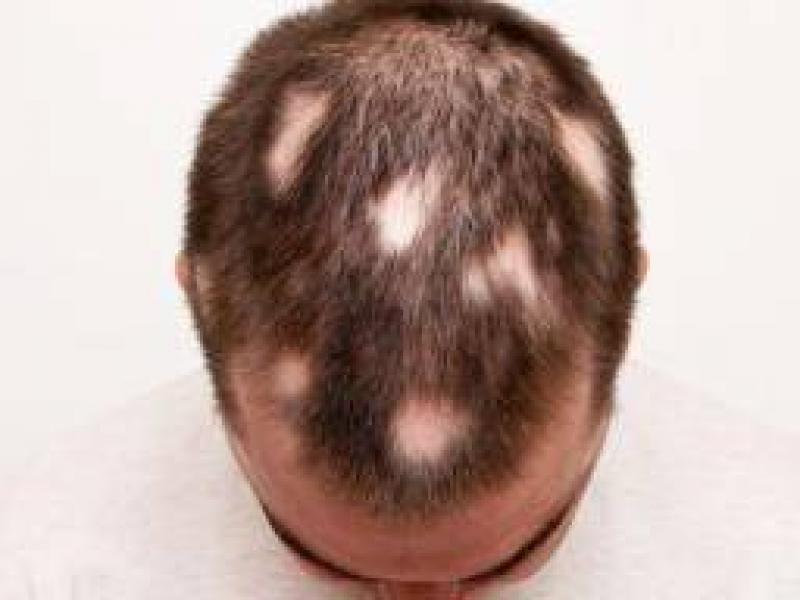 Alopesi Areata'nın Nedenleri, Belirtileri ve Tedavisi