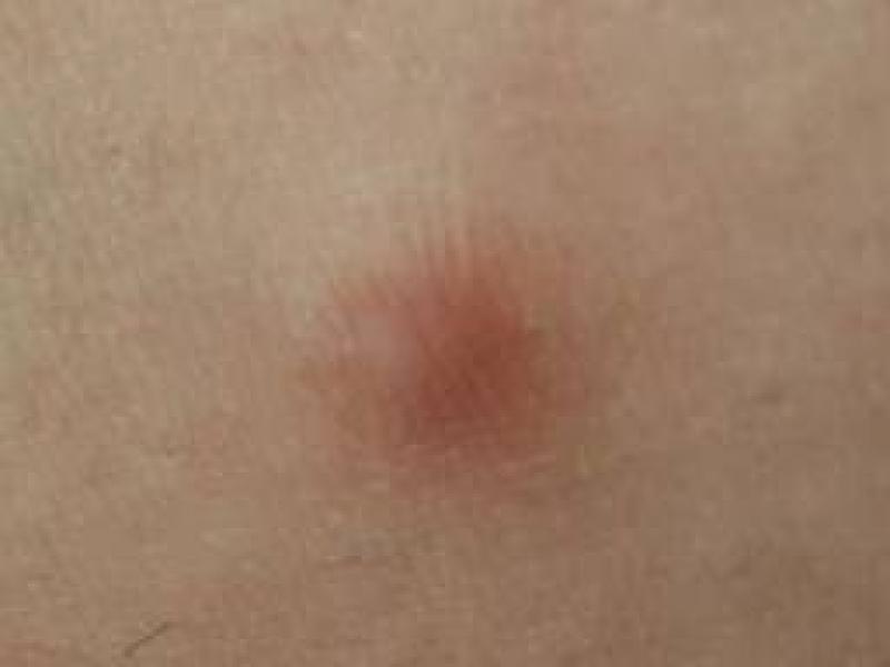 Dermatofibrom nedenleri ve tedavisi