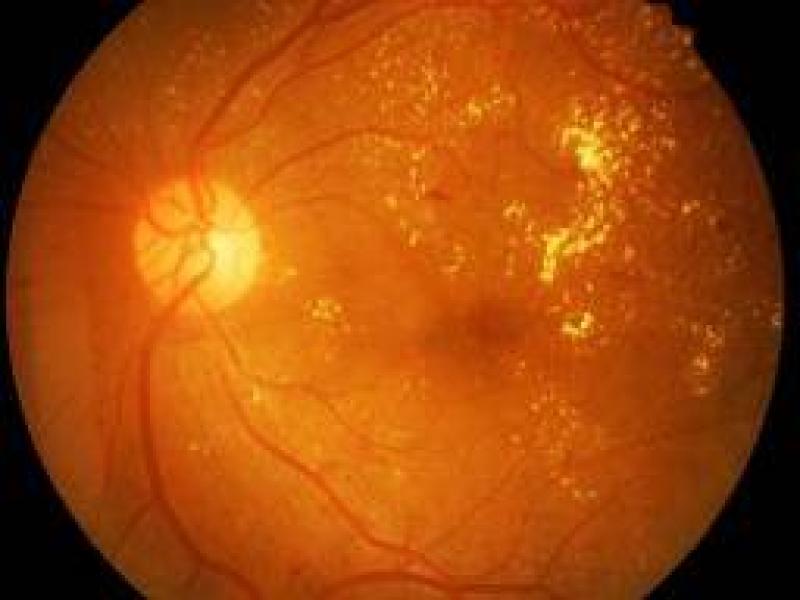 Diyabetik retinopati nedenleri, belirtileri ve tedavileri