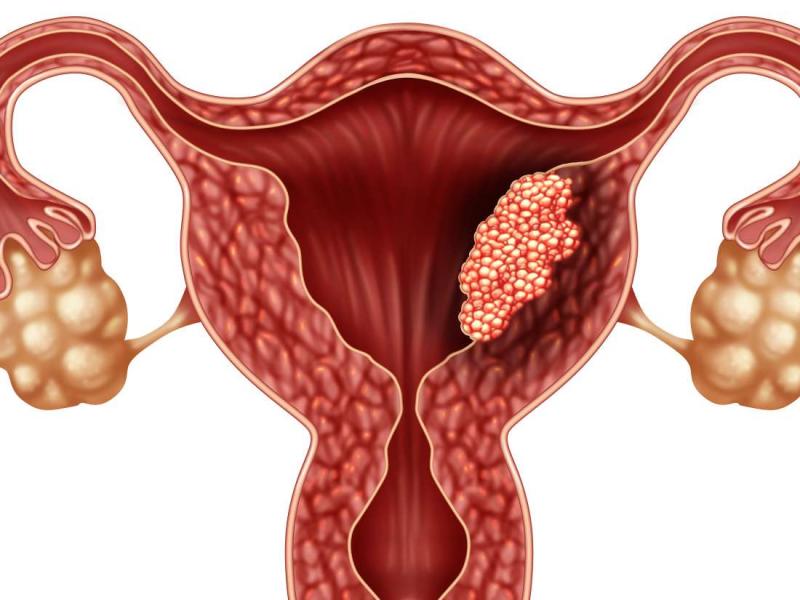 Endometrial kanser belirtileri, tedavisi ve nedenleri