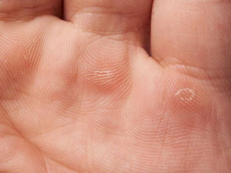 Epidermolysis bullosa etkileri, türleri ve belirtileri