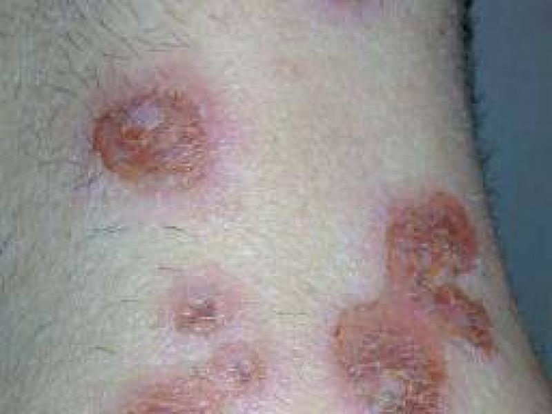 Impetigo tedavisi, belirtiler ve nedenleri