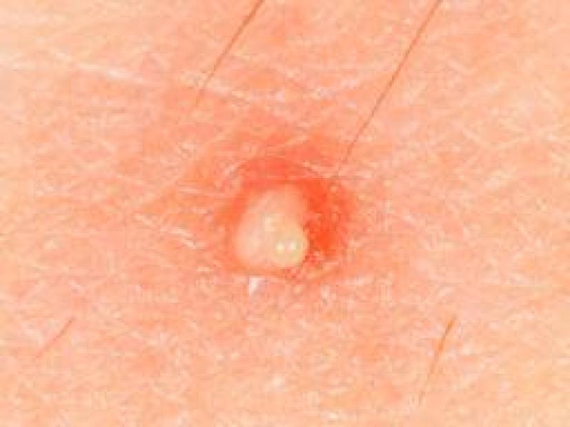 Molluscum contagiosum belirtileri, nedenleri ve tedavisi