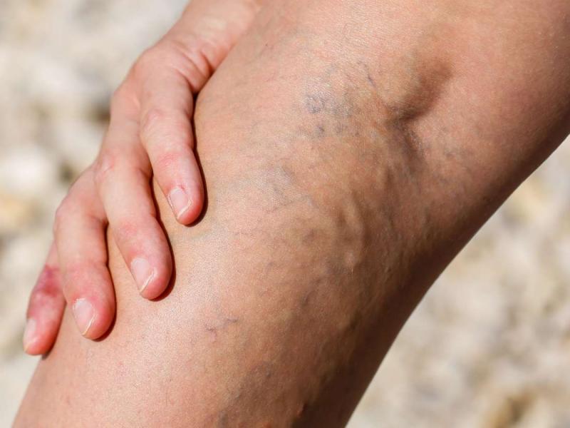 Varisli egzama veya staz dermatiti: Belirtileri, nedenleri ve tedavisi