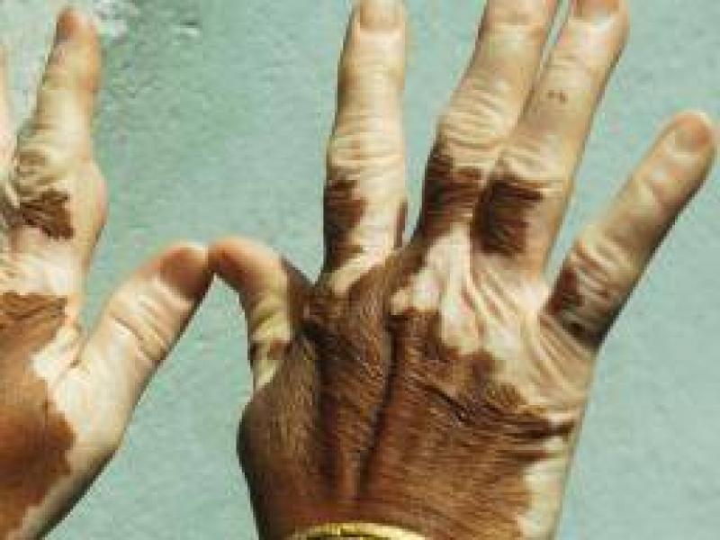 Vitiligo belirtileri, nedenleri ve tedavileri
