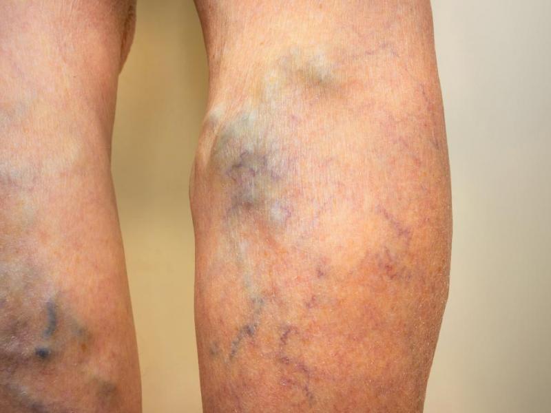 Derin ven trombozu ve pulmoner emboli belirtileri ve daha fazlası