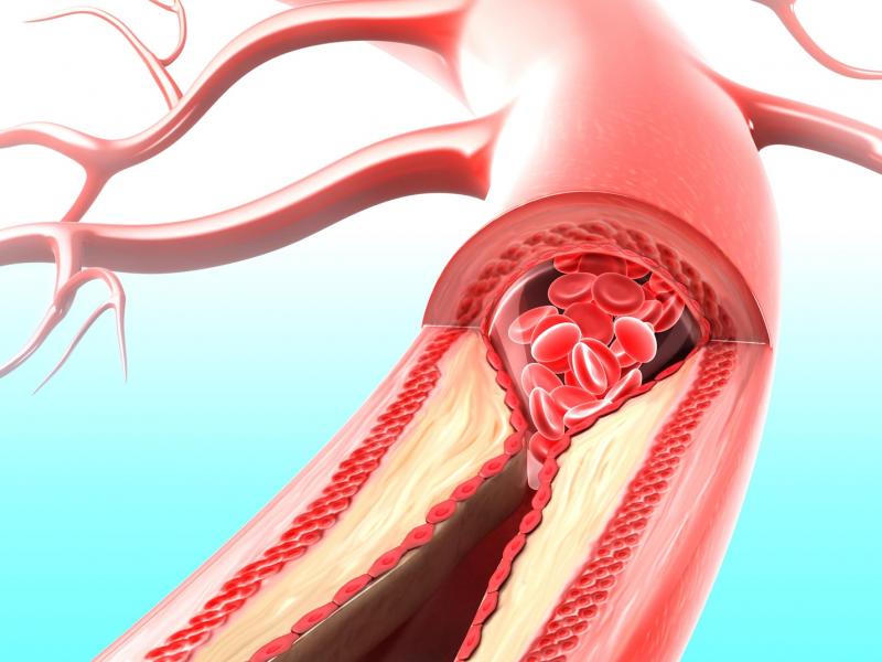 Periferik arter hastalığı belirtileri, tedavileri ve nedenleri